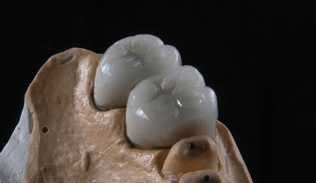 Dente incapsulato: quando è necessario?